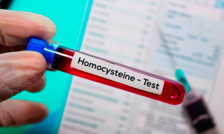 Homocysteín - merať či nemerať? To je otázka