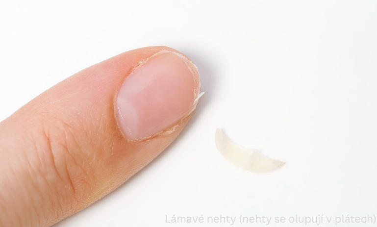 Lámavé nechty (nechty sa odlupujú v nánosoch) Lámavé nechty (nechty sa odlupujú v nánosoch)